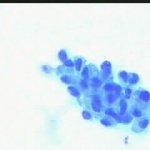 Ομαδα κυτταρων ενδοτραχήλου